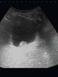 bladder cancer ultrasound