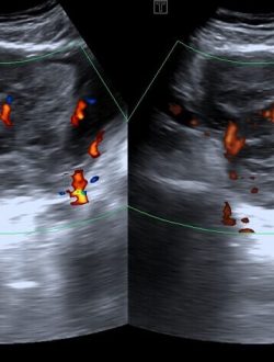 prostrate cancer ultrasound (1)