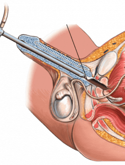 urethrotomy proceduce illustration mumbai